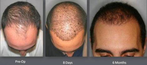Hair Transplant with NeoGraft.