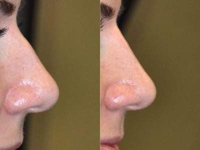 Non Surgical, Liquid Rhinoplasty / Nosejob