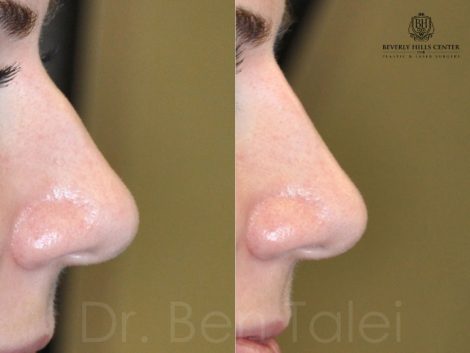 Non Surgical, Liquid Rhinoplasty / Nosejob