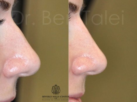 Non Surgical, Liquid Rhinoplasty / Nosejob
