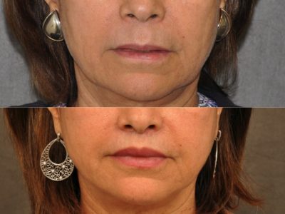 Modified Upper Lip Lift for Accent and Symmetry - Front