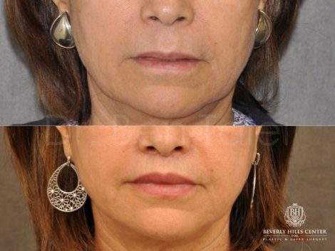 Modified Upper Lip Lift for Accent and Symmetry - Front