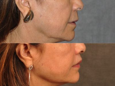 Modified Upper Lip Lift for Accent and Symmetry - Right Side