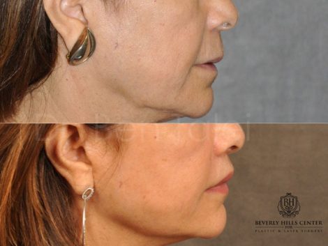 Modified Upper Lip Lift for Accent and Symmetry - Right Side