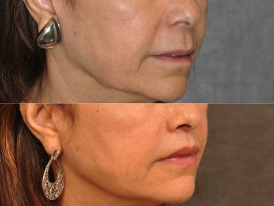 Modified Upper Lip Lift for Accent and Symmetry - Right Side