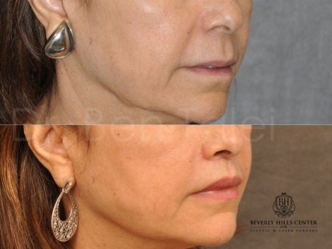 Modified Upper Lip Lift for Accent and Symmetry - Right Side