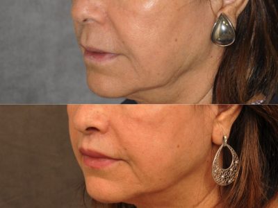 Modified Upper Lip Lift for Accent and Symmetry - Left Side