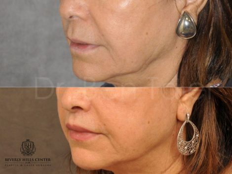 Modified Upper Lip Lift for Accent and Symmetry - Left Side