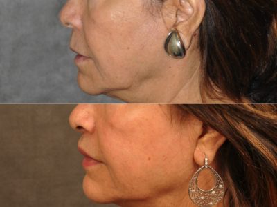 Modified Upper Lip Lift for Accent and Symmetry - Left Side