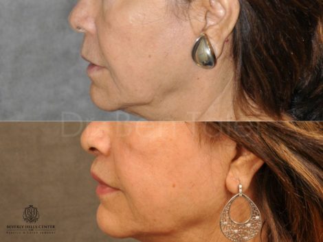 Modified Upper Lip Lift for Accent and Symmetry - Left Side