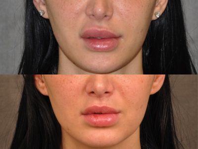 Modified Upper Lip Lift to Correct Over-Filling and Asymmetry - Front