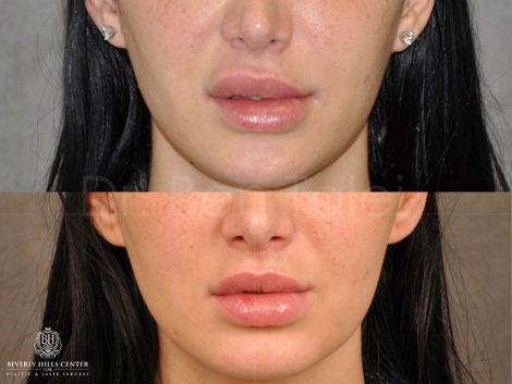Modified Upper Lip Lift to Correct Over-Filling and Asymmetry - Front