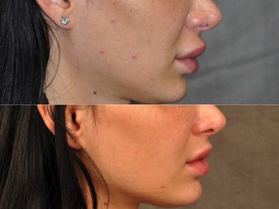 Modified Upper Lip Lift to Correct Over-Filling and Asymmetry - Right Side