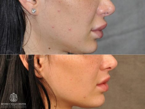 Modified Upper Lip Lift to Correct Over-Filling and Asymmetry - Right Side