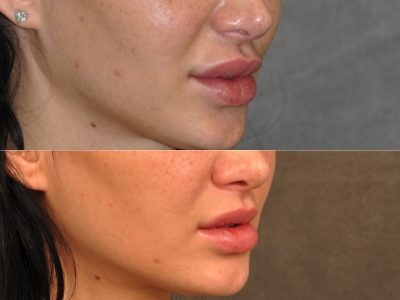 Modified Upper Lip Lift to Correct Over-Filling and Asymmetry - Left Side