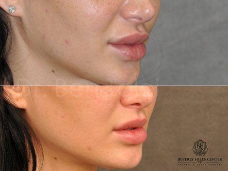 Modified Upper Lip Lift to Correct Over-Filling and Asymmetry - Right Side
