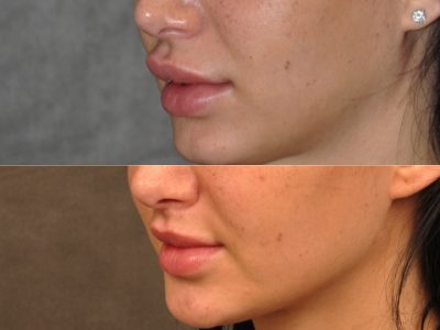 Modified Upper Lip Lift to Correct Over-Filling and Asymmetry - Left Side
