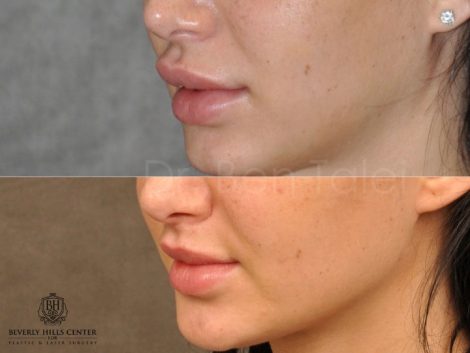 Modified Upper Lip Lift to Correct Over-Filling and Asymmetry - Left Side
