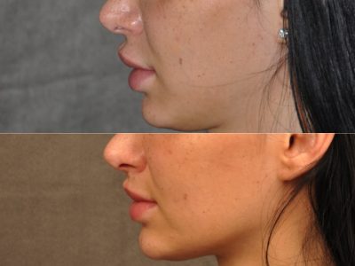 Modified Upper Lip Lift to Correct Over-Filling and Asymmetry - Right Side