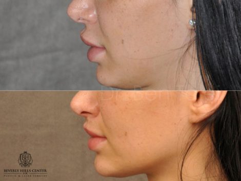 Modified Upper Lip Lift to Correct Over-Filling and Asymmetry - Left Side