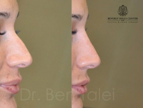 Beverly Hills Center Female Patient Before and After Non-surgical Liquid Rhinoplasty