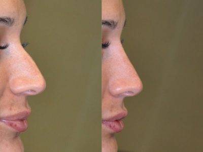 Non Surgical Rhinoplasty / Nosejob