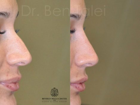Non Surgical Rhinoplasty / Nosejob