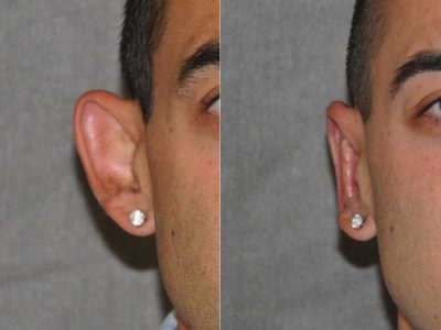 Otoplasty (Ear Pinning and Reshaping)