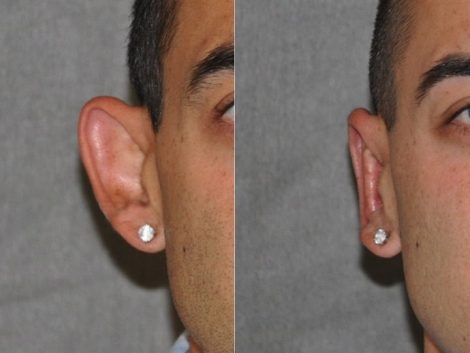 Otoplasty (Ear Pinning and Reshaping)