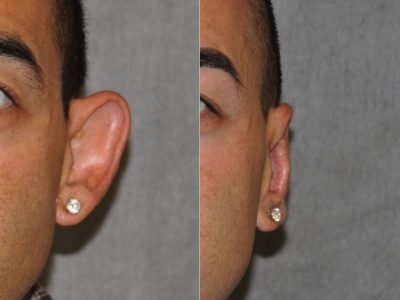 Otoplasty (Ear Pinning and Reshaping)