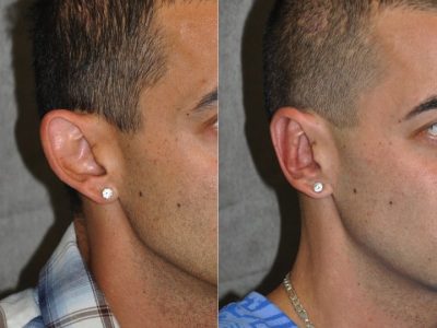 Otoplasty (Ear Pinning and Reshaping)