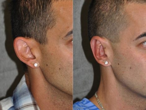 Otoplasty (Ear Pinning and Reshaping)