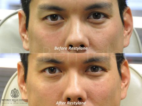 Beverly Hills Center Male Patient Before and After Non-surgical Eye Rejuvenation