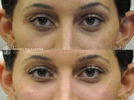 Beverly Hills Center Female Patient Before and After Non-surgical Under Eye Rejuvenation Procedure