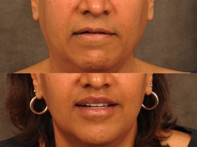 Modified Upper Lip Lift for feminization – Front