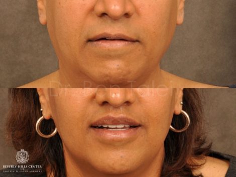 Modified Upper Lip Lift for feminization - Front