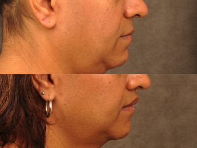 Modified Upper Lip Lift for feminization – Right Side