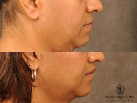 Modified Upper Lip Lift for feminization - Right Side