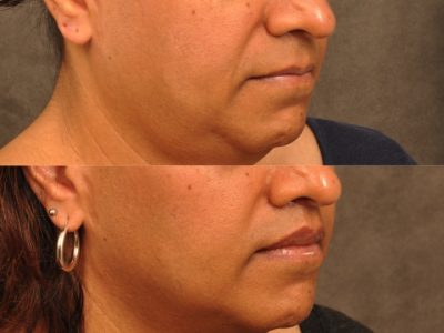 Modified Upper Lip Lift for feminization – Right Side