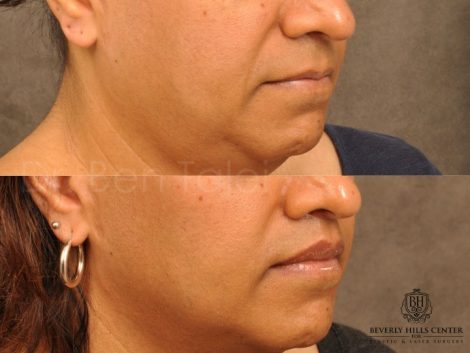 Modified Upper Lip Lift for feminization - Right Side
