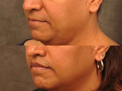 Modified Upper Lip Lift for feminization – Left Side