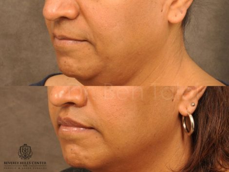 Modified Upper Lip Lift for feminization - Left Side