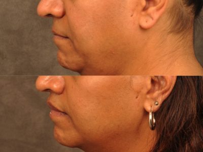 Modified Upper Lip Lift for feminization – Left Side