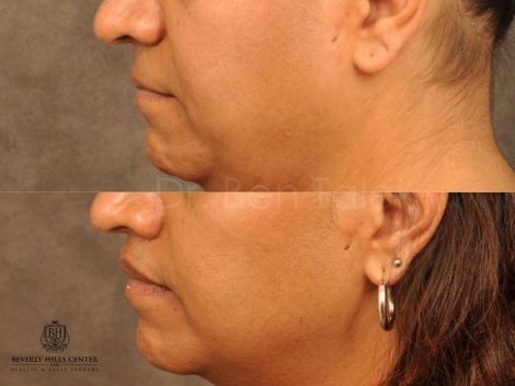 Modified Upper Lip Lift for feminization - Left Side