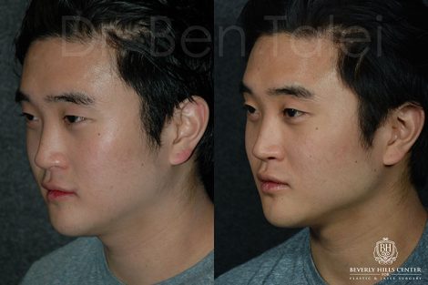 Beverly Hills Center Asian Male Patient Before and After Non-surgical Cheek Procedure
