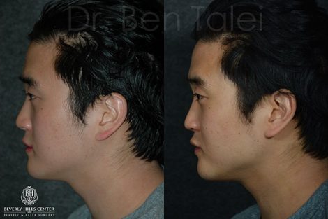 Beverly Hills Center Asian Male Patient Before and After Non-surgical Cheek Procedure