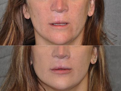Modified Upper Lip Lift to revise cleft lip scarring - Front