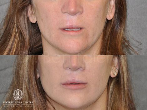 Modified Upper Lip Lift to revise cleft lip scarring - Front