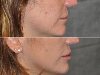 Modified Upper Lip Lift to revise cleft lip scarring - Right Side