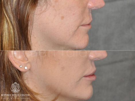 Modified Upper Lip Lift to revise cleft lip scarring - Right Side